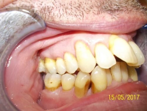 Mordida abierta anterior, antes del tratamiento