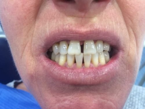Rehabilitación con coronas de zirconio, antes del tratamiento