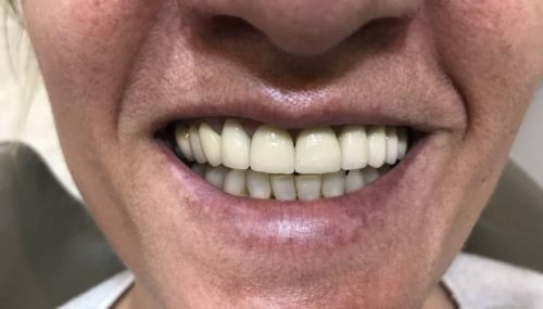 Rehabilitación con implantes y sobredentadura, con locators, después del tratamiento